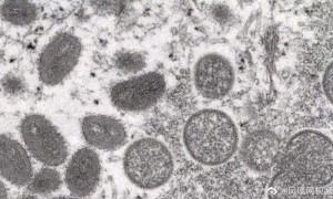 猴痘会成为下一个大流行病毒吗