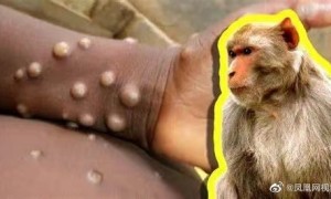 猴痘会成为下一个大流行病毒吗